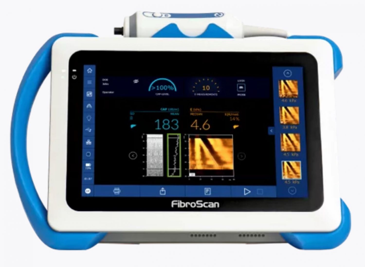 Fibroscan