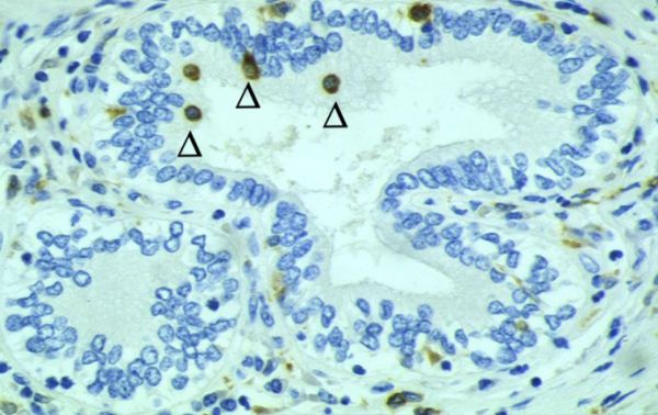 biliäre Cholangitis